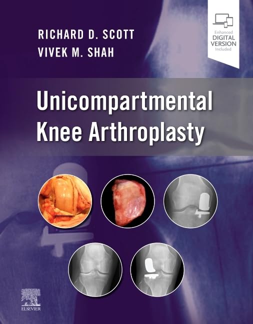  UNICOMPARTMENTAL KNEE ARTHROPLASTY 