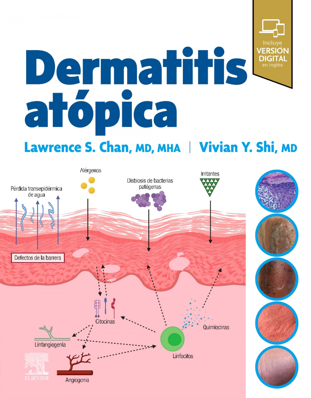 Dermatitis atopica