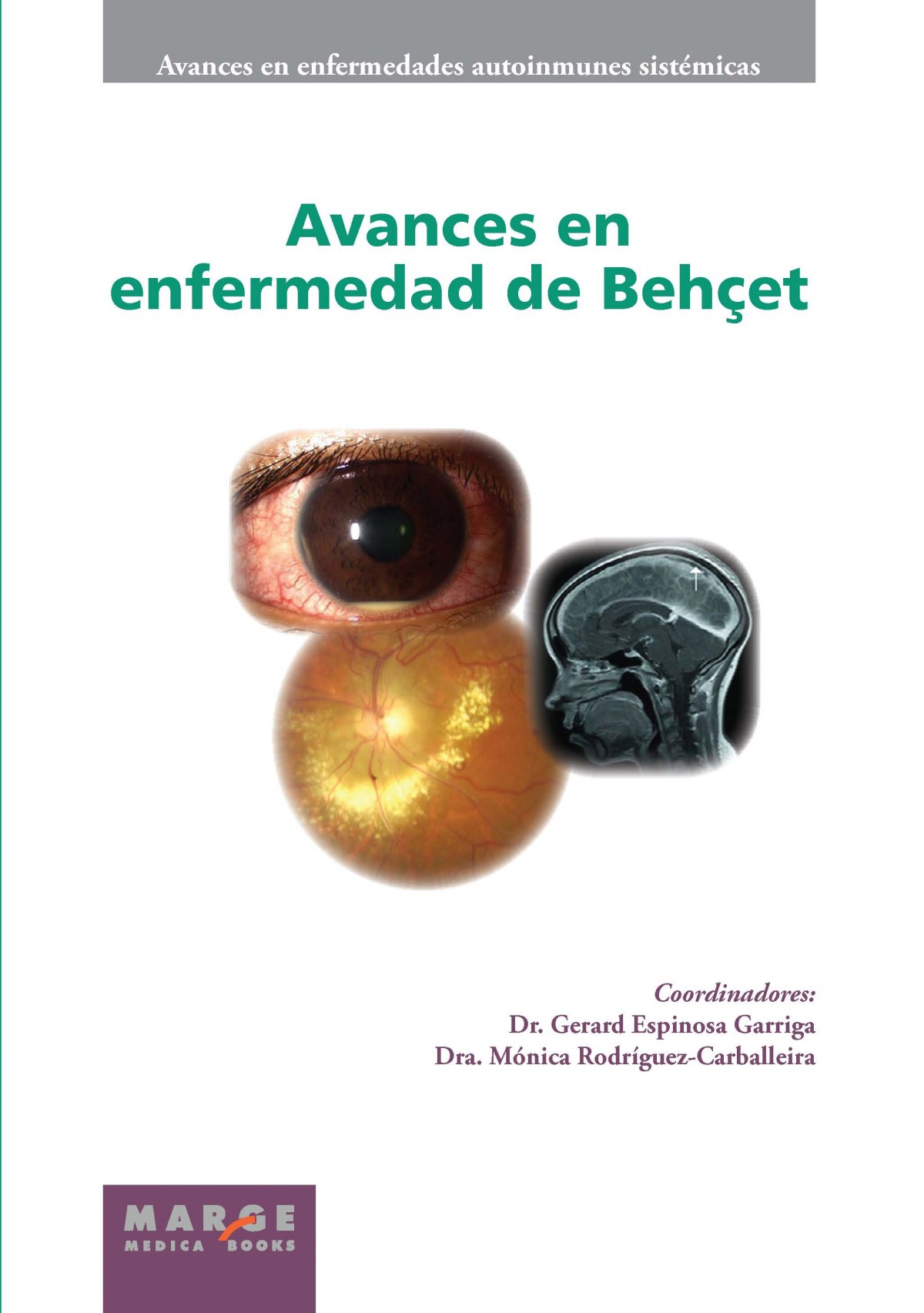 Avances en enfermedad de Behcet